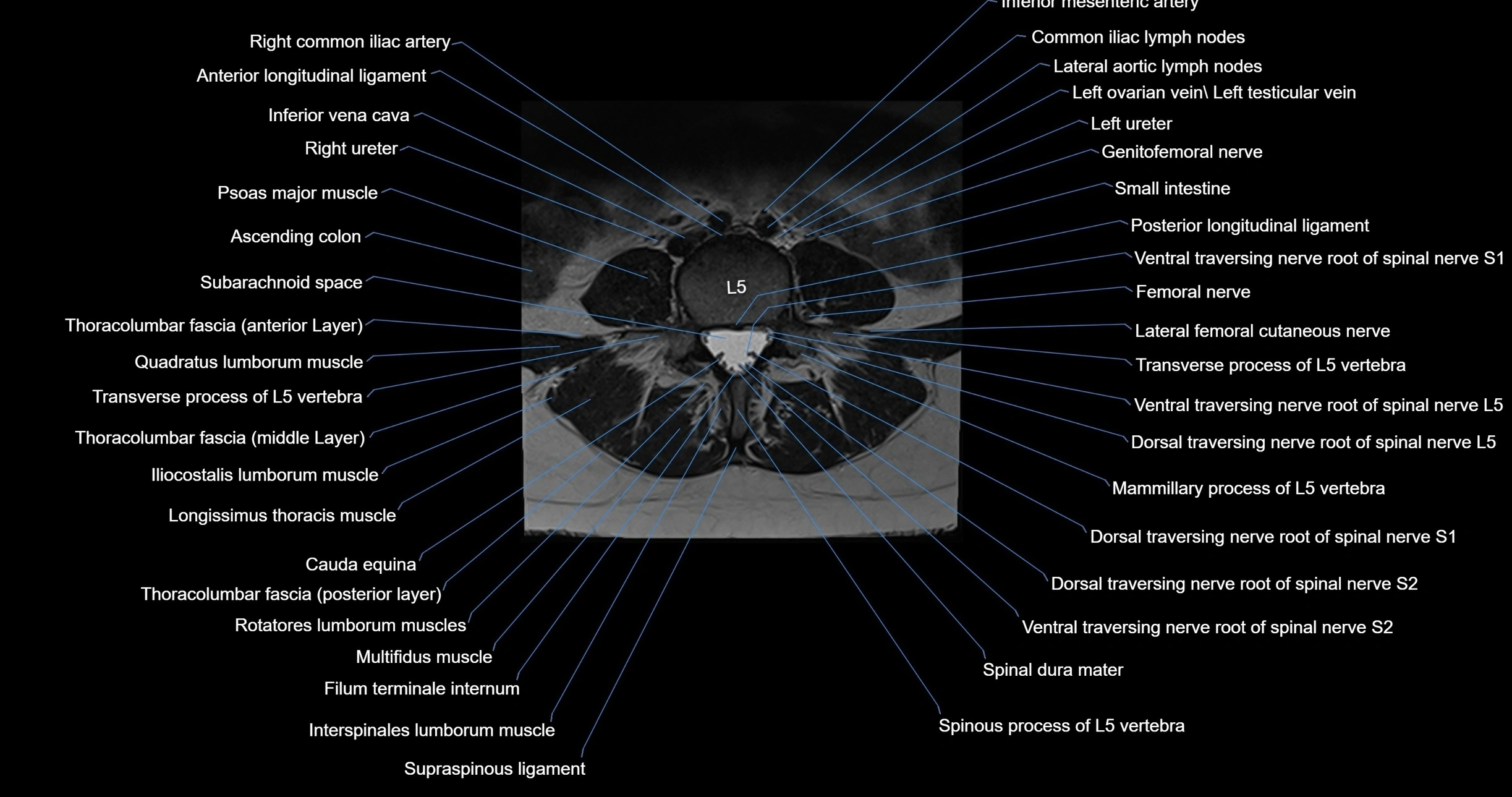 MRI lumbar spine axial cross sectional anatomy 3T radiology  image-img-00001-00036.webp